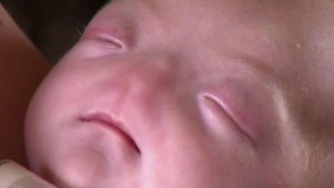 Eli Thompson, un bebé sin nariz