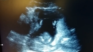 Vídeo de bebé aplaudiendo en una ecografía
